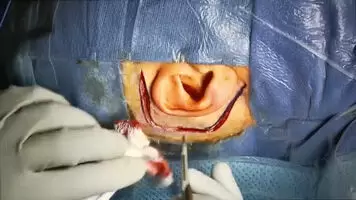 Removing a Brain Tumour